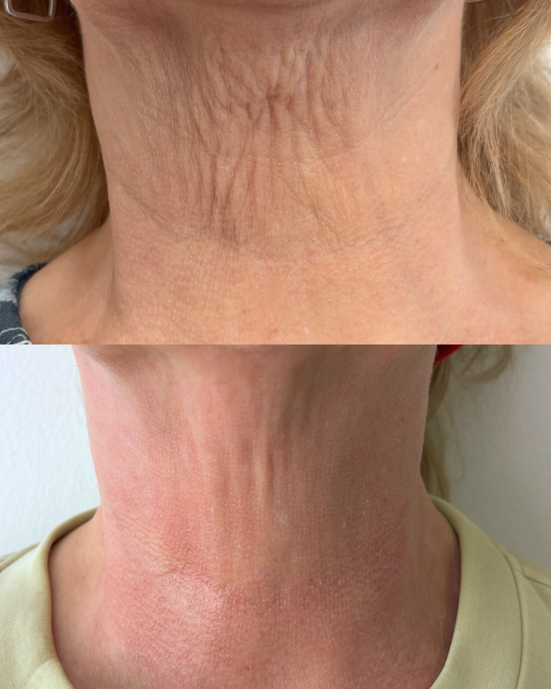Before and after neck skin rejuvenation at FAM Clinic
